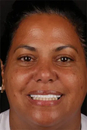 Bright and natural smile of a patient after receiving implant-supported dentures.